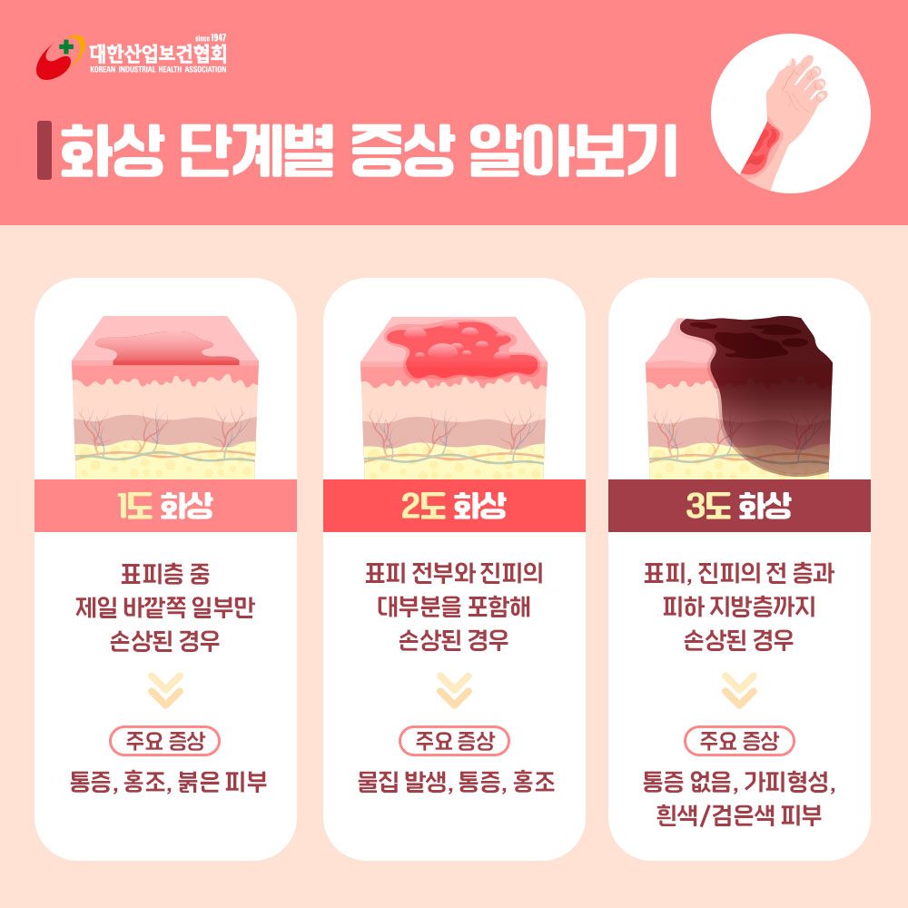 화상-응급처치2